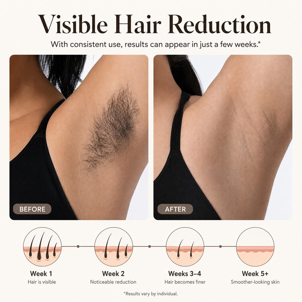 Laser Hair Removal Device R555